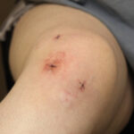 What To Expect During Knee Arthroscopy