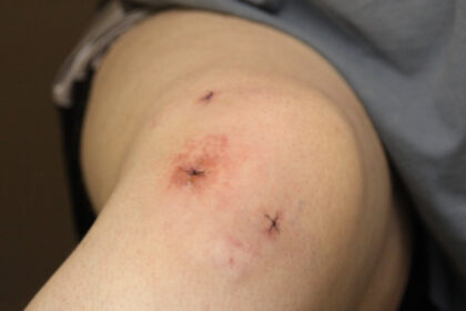 What To Expect During Knee Arthroscopy
