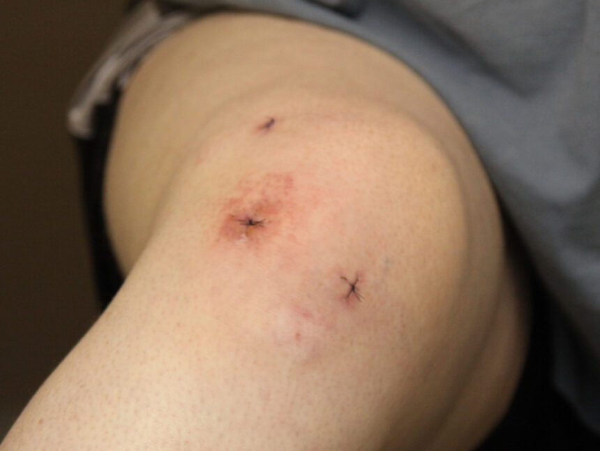 What To Expect During Knee Arthroscopy
