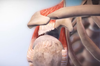 When do I Know I Need Rotator Cuff Tear Surgery?