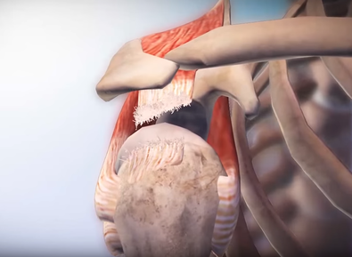 When do I Know I Need Rotator Cuff Tear Surgery?