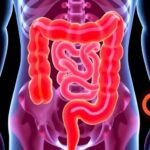 Why a Colonoscopy Is Key for Colorectal Cancer Screening