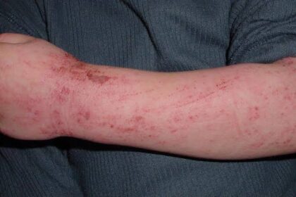Allergy Types, Symptoms, and Treatments