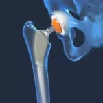Choosing Between Hip Replacement Surgery and Alternative Treatments