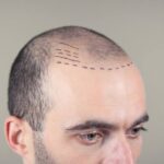 Choosing the Best Hair Transplant Method for Your Needs