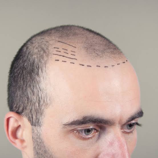 Choosing the Best Hair Transplant Method for Your Needs