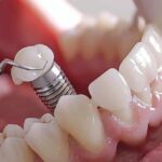 Exploring Custom Tooth Replacement Solutions For Individual Needs