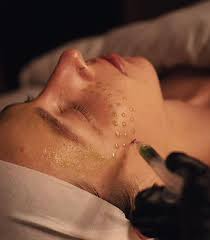 Exploring Treatments for Rosacea