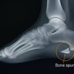 FAQs About Heel Pain