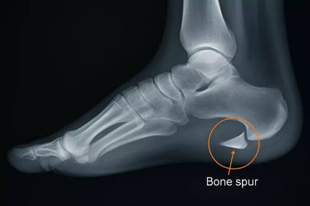 FAQs About Heel Pain