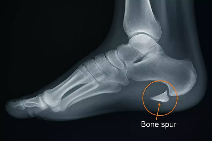 FAQs About Heel Pain