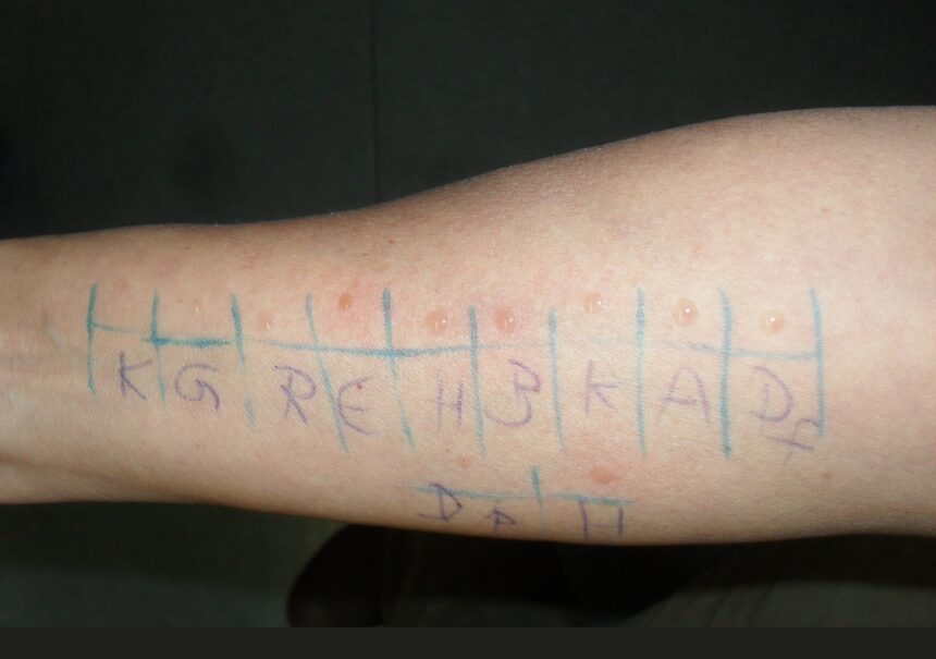 How Does Allergy Testing Work?