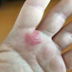 How a Dermatologist Helps Treat Eczema
