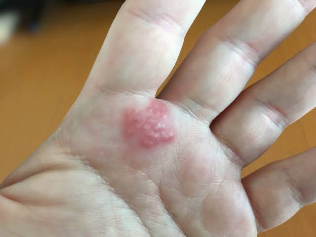 How a Dermatologist Helps Treat Eczema