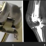 Innovations in Knee Replacement Techniques