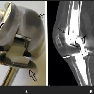 Innovations in Knee Replacement Techniques