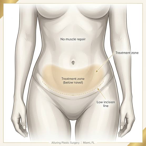 Long-term Benefits of a Tummy Tuck