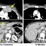 MRI and Cancer Treatment Planning