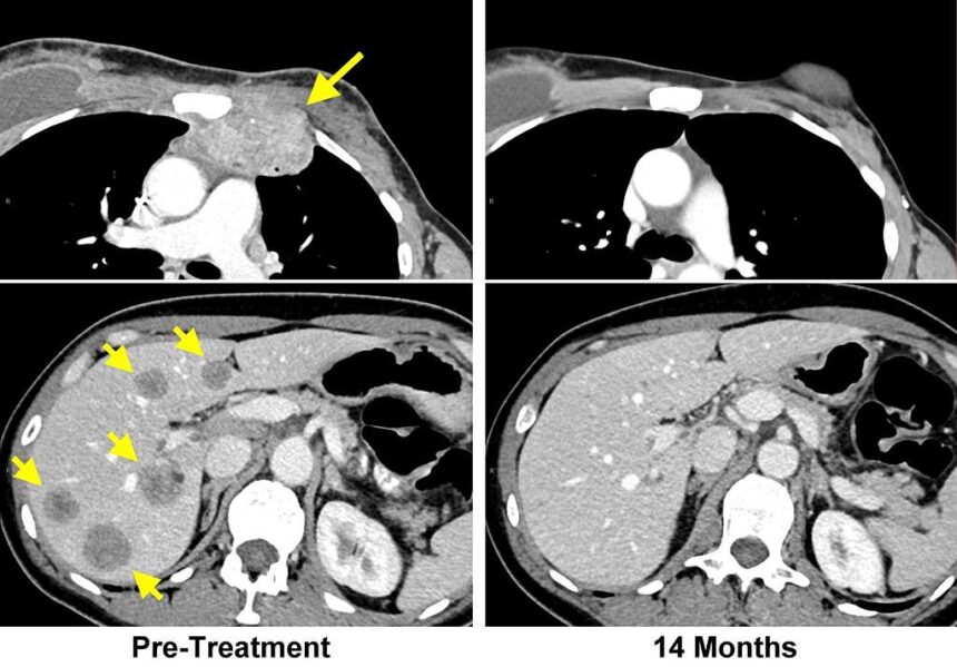 MRI and Cancer Treatment Planning