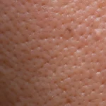 The Long-Term Benefits of Mohs Micrographic Surgery for Skin Health