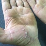 Understanding How Psoriasis Is Diagnosed
