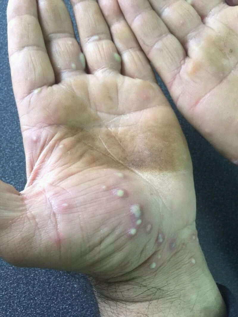 Understanding How Psoriasis Is Diagnosed