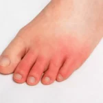 Understanding Treatment and Recovery Options for Deep Vein Thrombosis