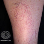 What Causes Spider Veins and How They Are Treated