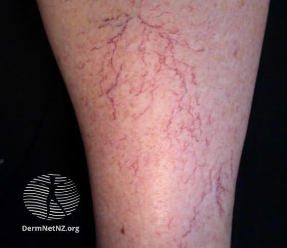 What Causes Spider Veins and How They Are Treated