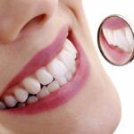 What to Expect from Tooth Sensitivity After Veneer Treatments