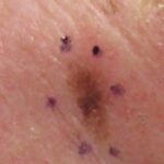 When To Consult a Dermatologist for Skin Concerns