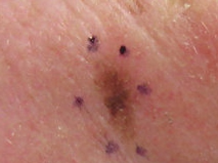 When To Consult a Dermatologist for Skin Concerns